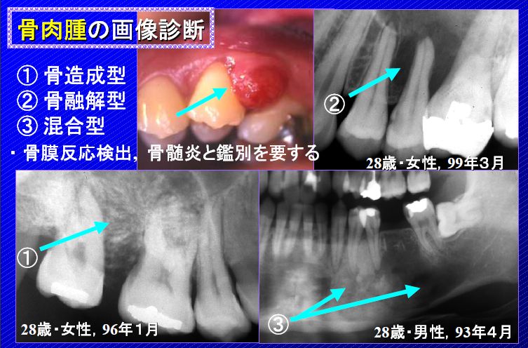 骨肉腫 舌癌の症状 治療法 名医情報総合サイト